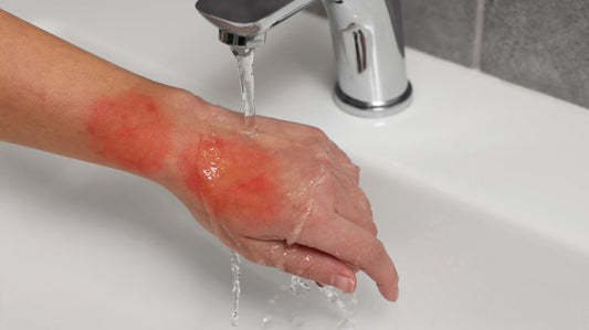 Phone of worker treating a burn at work by running cold water.